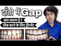 दाँतो मे gap आ जाए तो क्या करे | Midline diastema in Hindi | samne ke daanto me gap