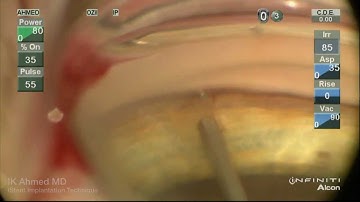 iStent Trabecular MicroBypass Implantation Ike Ahmed