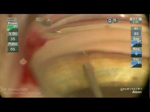 Video: Trabekuläre Mikro-Bypass-Stentimplantation Der Zweiten Generation: Retrospektive Analyse Nach 12- Und 24-monatiger Nachuntersuchung