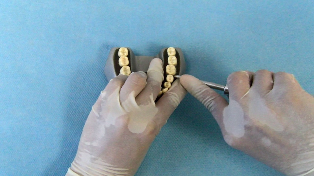 Extracción de un molar inferior