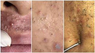 Extremely satisfying blackheads exfoliation, for blackheads and pimples TikTok compilation : pt. 4 : screenshot 4