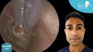 1,341 - Painful Ear Wax Plug Squashed Against Eardrum with Cotton Swab Extracted