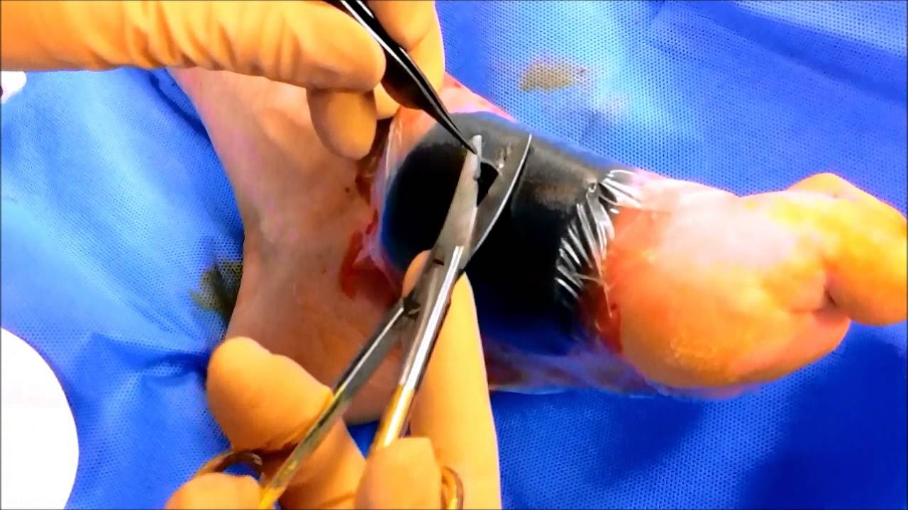 Topical Negative Pressure Wound Therapy, VAC - YouTube