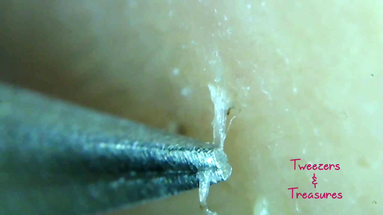 You Won T Believe The Ingrown Hairs I Can Pluck Youtube