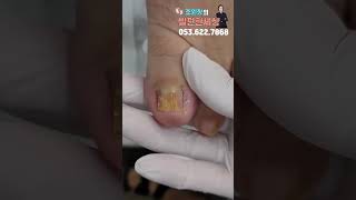 내성발톱 편안하게 관리 #shorts #대구내성발톱  #대구무좀발톱 #대구발톱 #ingrown #toenails