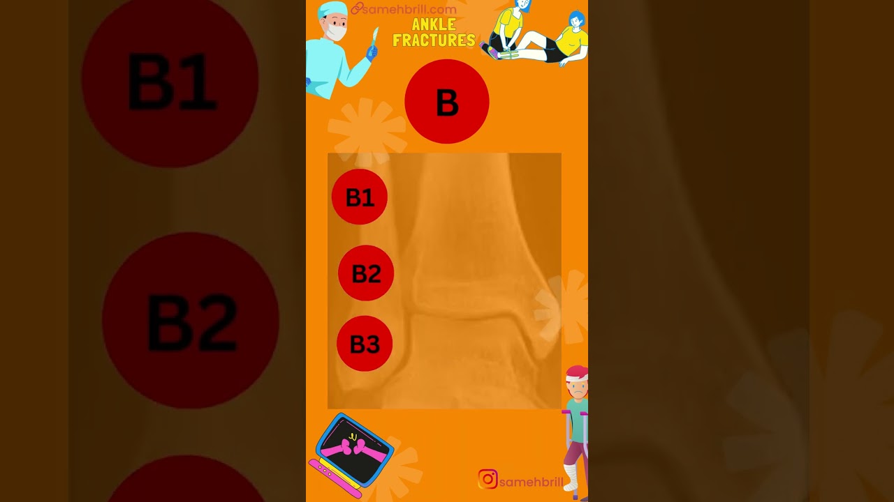 AO CLASSIFICATION OF ANKLE FRACTURES VARIANT B (44-B)