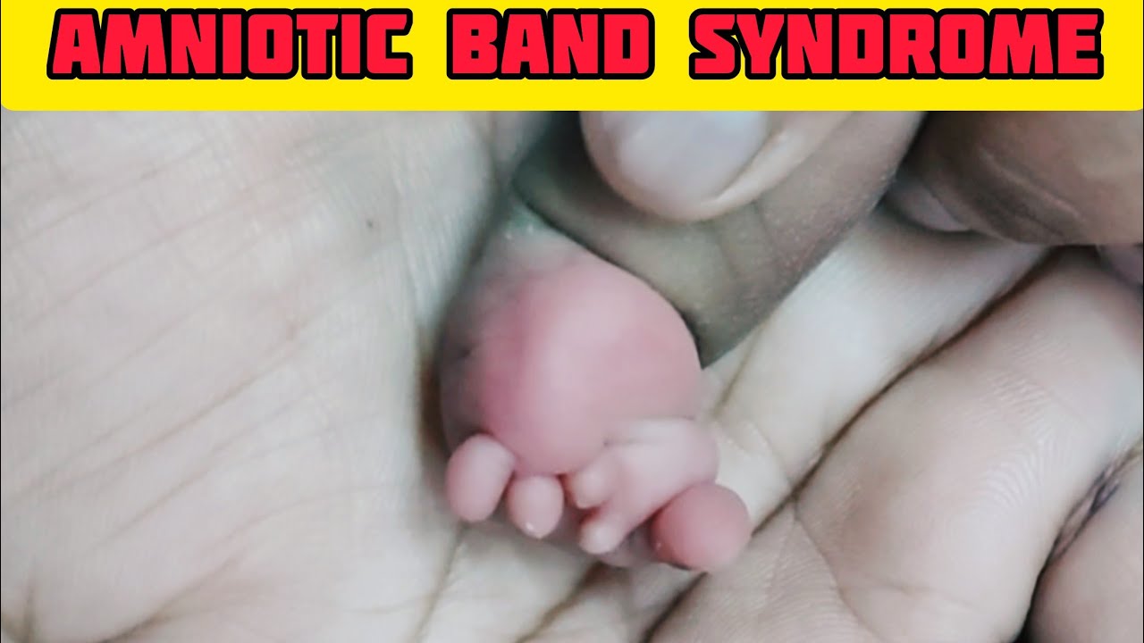 Amniotic Band Syndrome. - YouTube