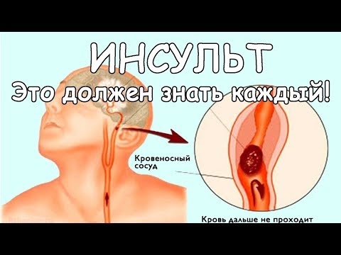 ИНСУЛЬТ: Запомните всего 3 первых шага, чтобы спасти себе и близким жизнь! Симптомы и Причины