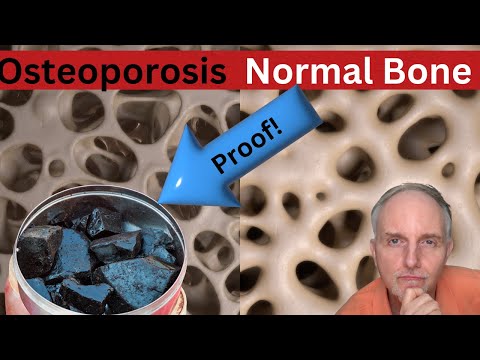 Shilajit & Osteoporosis: Fact or Fiction?
