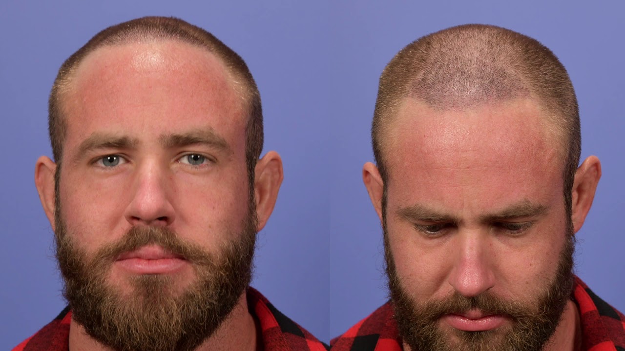 Hair Transplant Surgery - FUE Hair Transplant | Gabel Center