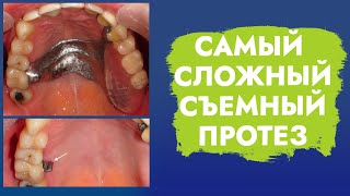 видео: Нет зубов с одной стороны. Односторонний концевой дефект. картинка: Нет зубов с одной стороны. Односторонний концевой дефект.
