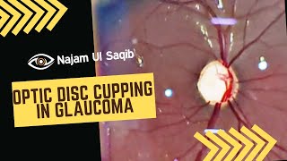 Optic Disc Cupping In Glaucoma (Glaucomatous Optic Nerve Damage)