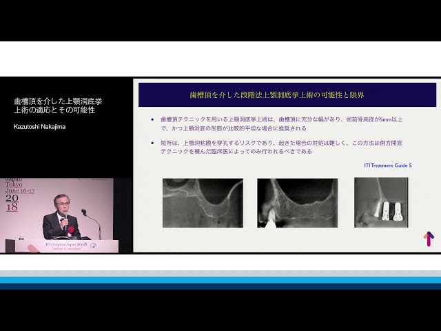 ITI Treatment Guide Volume 5 上顎洞底挙上術 歯槽頂を介した上顎洞底挙上術の適応とその可能性 | 中島 和敏 - YouTube
