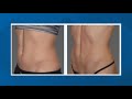 Tone and sculpt your body with magnetic muscle stimulation - New Day NW