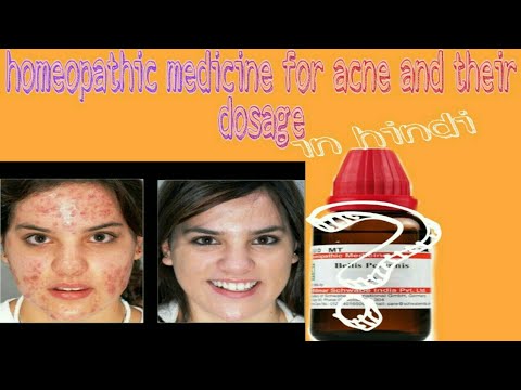 Treatment of acne vulgaris in homepathy