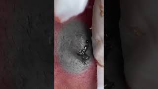 Big Cystic Acne Blackheads Extraction Blackheads & Milia, Whiteheads Removal Pimple Popping #shorts