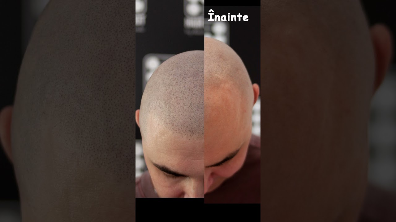 Adio Chelie Micropigmentare Scalp