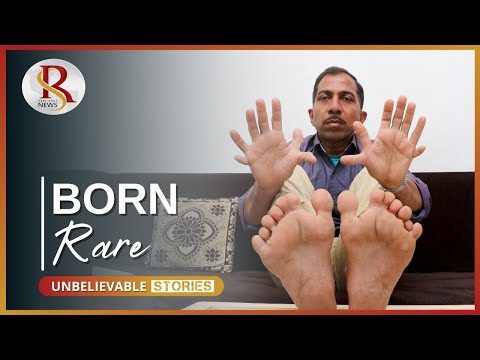 Video: In The USA, A Boy Was Born With 24 Fingers And Toes - Alternative View