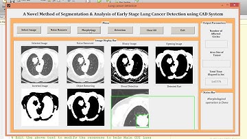 Lung cancer detection using computer aided system MATLAB project source code
