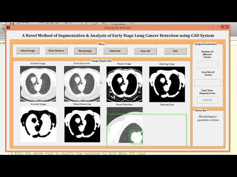 Lung cancer detection using computer aided system MATLAB project source code