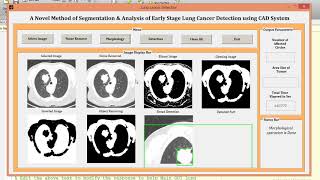Lung cancer detection using computer aided system MATLAB project source code