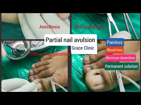 Partial Nail Removal (Matrixectomy) - Houston, TX: Spring Branch Podiatry,  PLLC