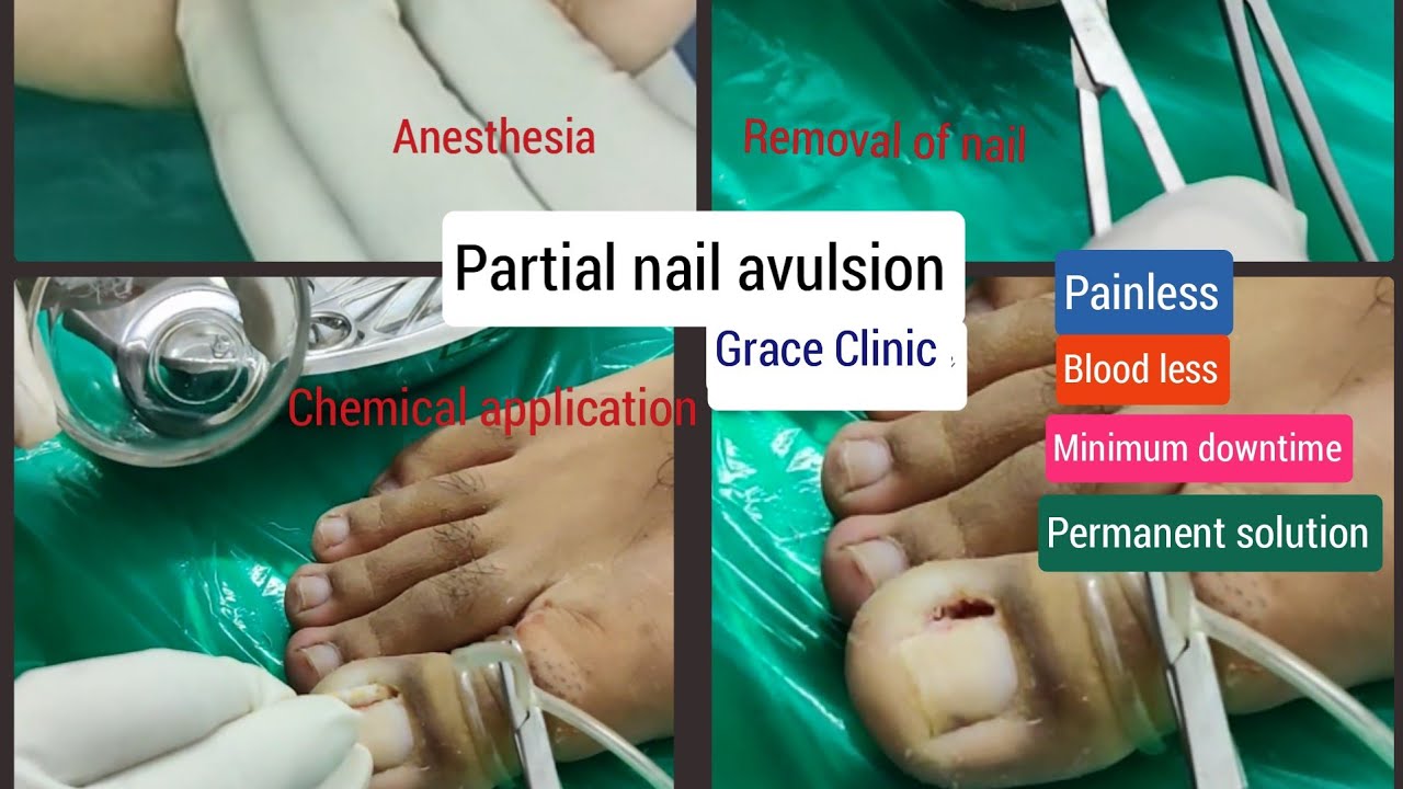 Surgical Technique for Femoral Intramedullary Bent Nail Removal: A Case  Report and Review of the Literature (