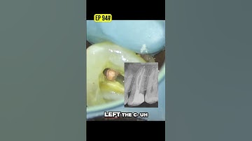 Modified Tunnel Technique  Composite Preservation Explained