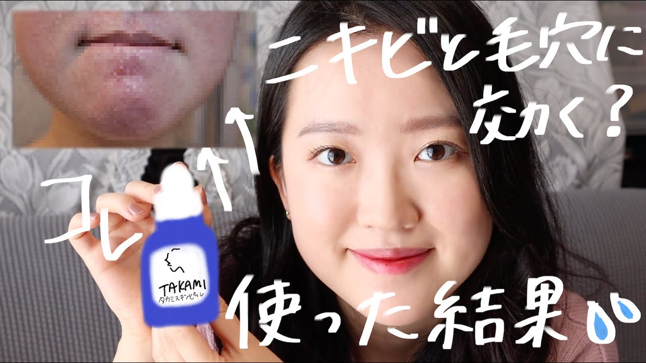 Eng)【閲覧注意】毛穴とニキビに効くタカミスキンピールを使ったら残念な結果に I tried Japanese pore minimizing  products Takami Skin Peel - YouTube