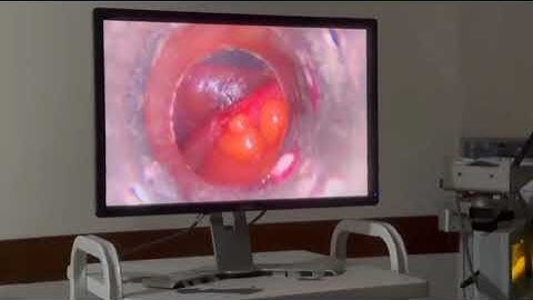Emergency Laparoscopic appendectomy for Gangrenous appendix due to faecolithe