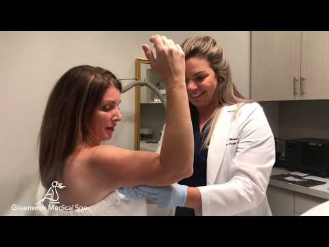 Vídeo: CoolSculpting For Arms: Procedimento, Custo, Efeitos Colaterais E Fotos