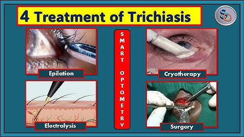 How to Treat Trichiasis- Epilation, Electrolysis, Cryo-Epilation, and Surgery.
