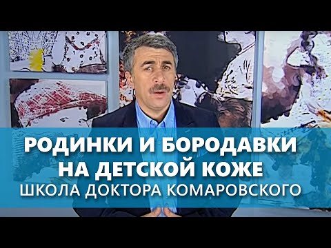 Родинки и бородавки на детской коже - Школа доктора Комаровского