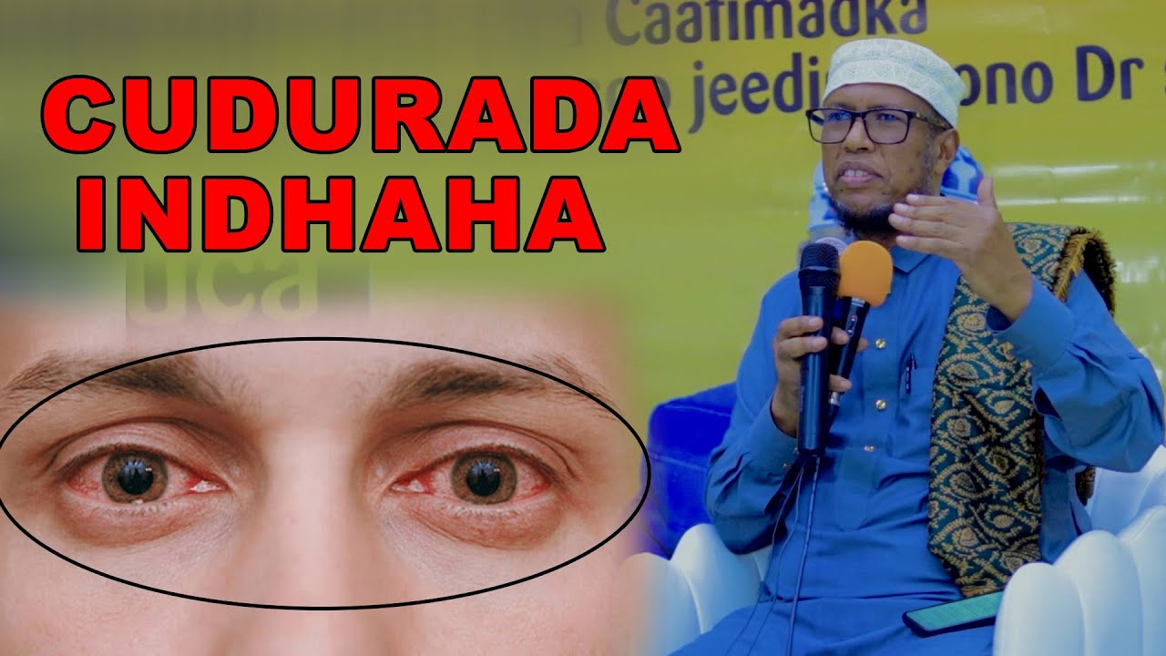 Cuduradda Indhaha ku dhaca maxaa sababa ?  Dr Shiine ayaa ka waramaya.