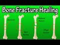 The Healing Journey of Bone Fractures and Cellular Roles