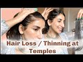 Hair Thinning At Temples or Receding Hair Line Cover Up with Nish Hair