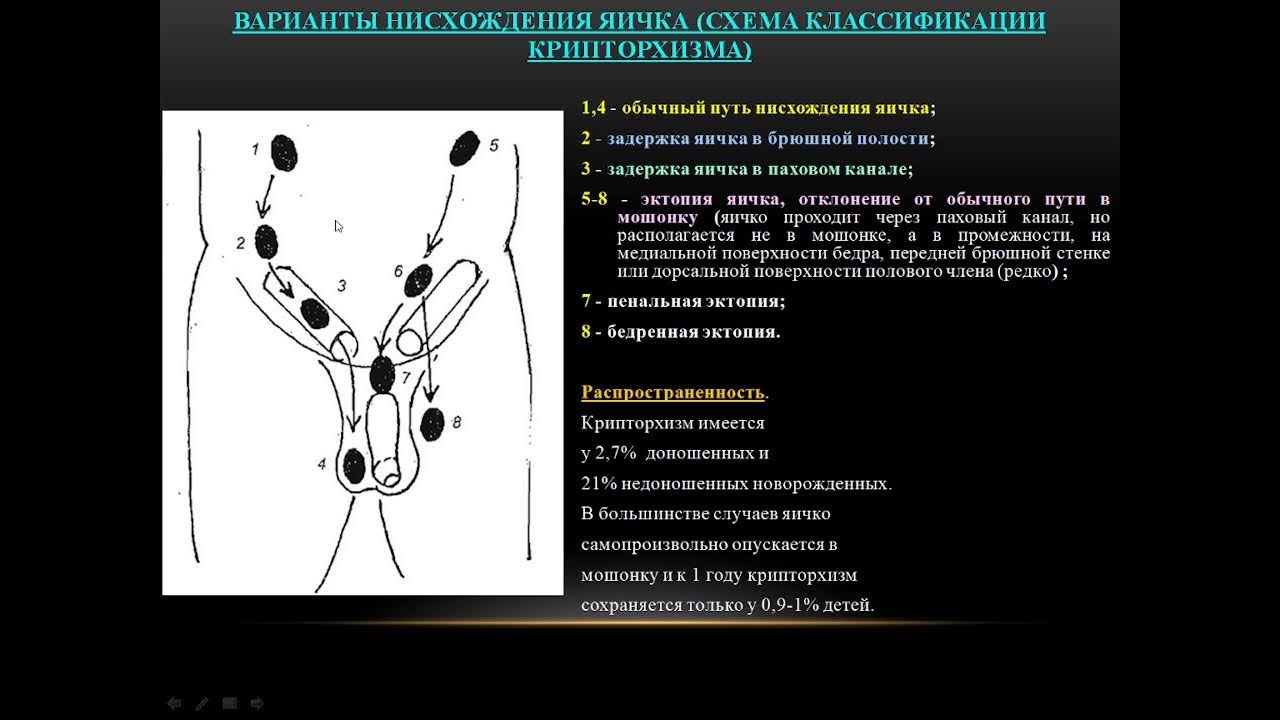 Крипторхизм лечение