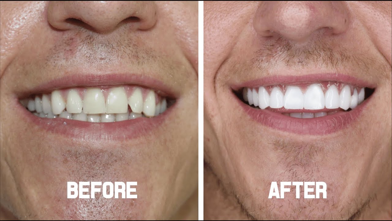 Hollywood Smile ( Zirconia Crowns ) - Kaman from the UK