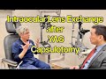 Intraocular lens exchange of single piece acrylic lenses after yag capsulotomy shannon wong md