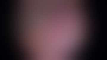 laparoscopic liver segmentectomy 8 for hepatocellular carcinoma