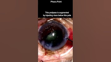 The dreaded Bowl in a soft cataract - Putting  plan B into action