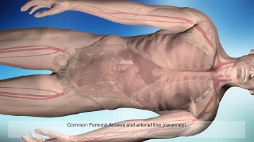 ER-REBOA™ Procedure