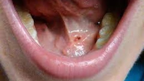 sialodochoplasty CPT code - simplify medical coding