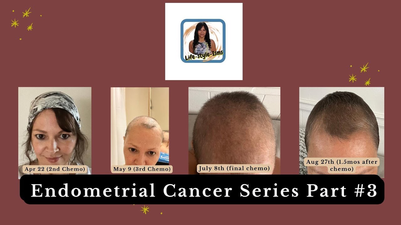 Chemo Hair Loss & Does Cold Cap Work?. Part 3 YouTube