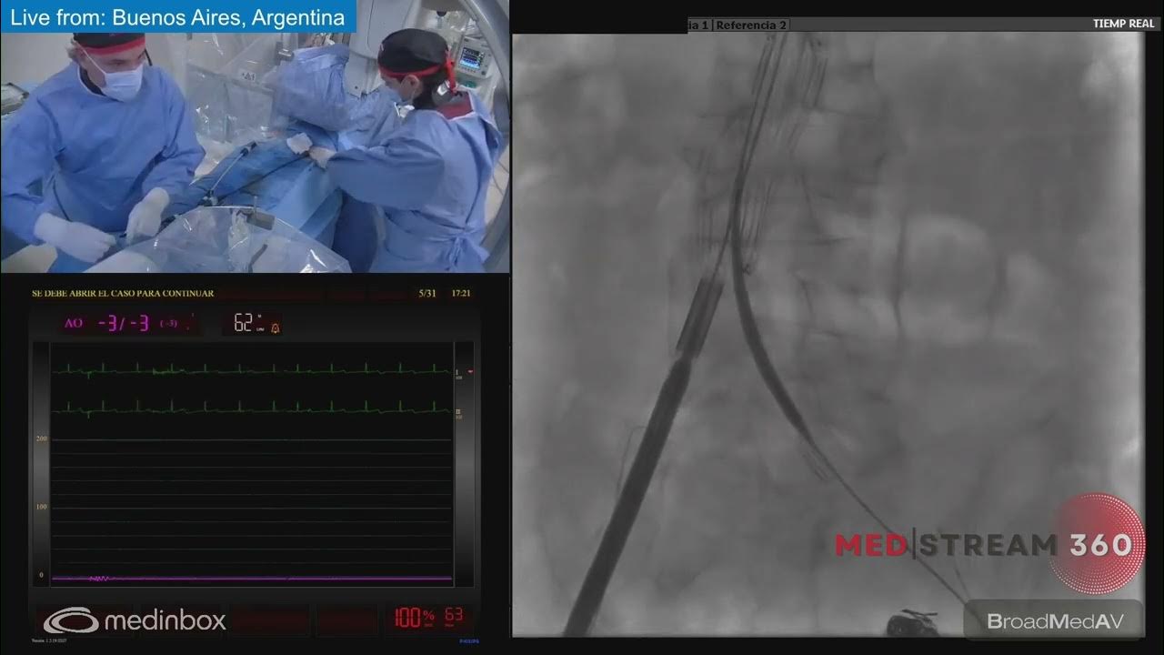 EVAR + Left Hypogastric Artery Embolization YouTube