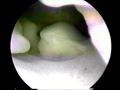 Perimenopausal bleeding multiple polyposis on hysteroscopy