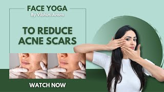 Heal acne scars with House of Beauty Reduce Acne scars FaceyogabyVibhutiArora #acne #yoga #acnescar