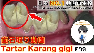 上尾の歯医者の歯周病治療。8年分の歯石取り動画　part２ tartar　Karang gigi　تحجيم الأسنان　AMSR・健康