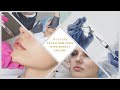 Full Face Dermal Filler! 😱 Here's what REALLY happened!