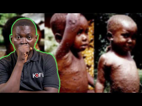 Stay Safe!! Mpox on the rise in Ghana